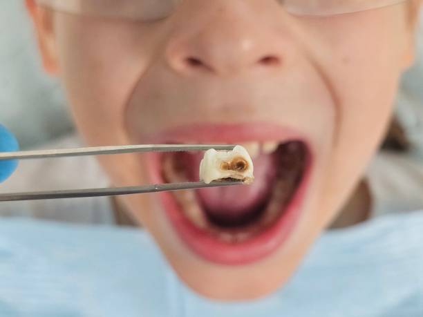 Best Emergency Root Canal Treatment in Essexville, MI